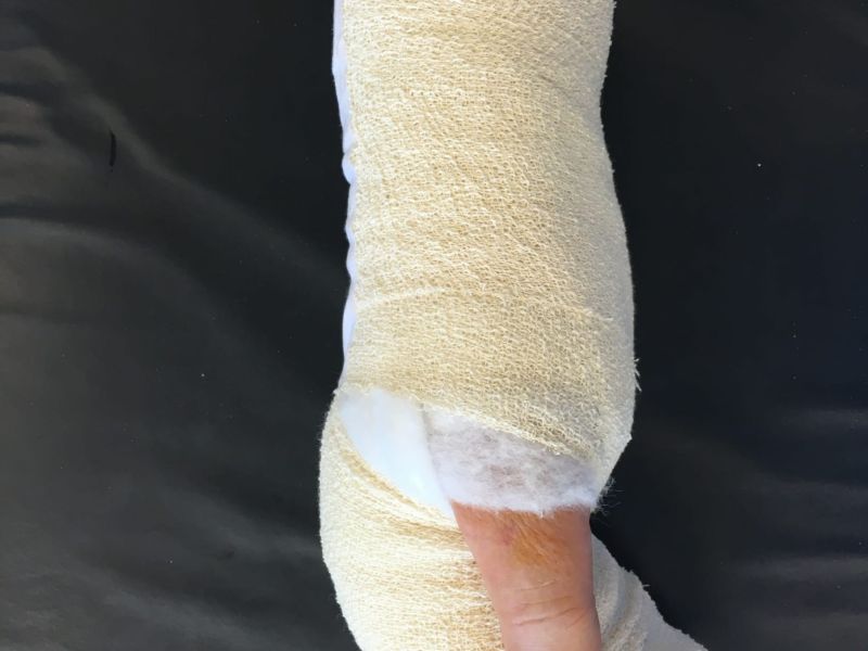 Hand affected by Dupuytren's disease, with dressing applied after the Dermofasciectomy